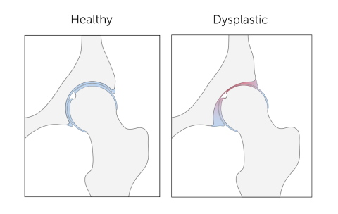 Hip Dysplasia in Football Players The Football Physio