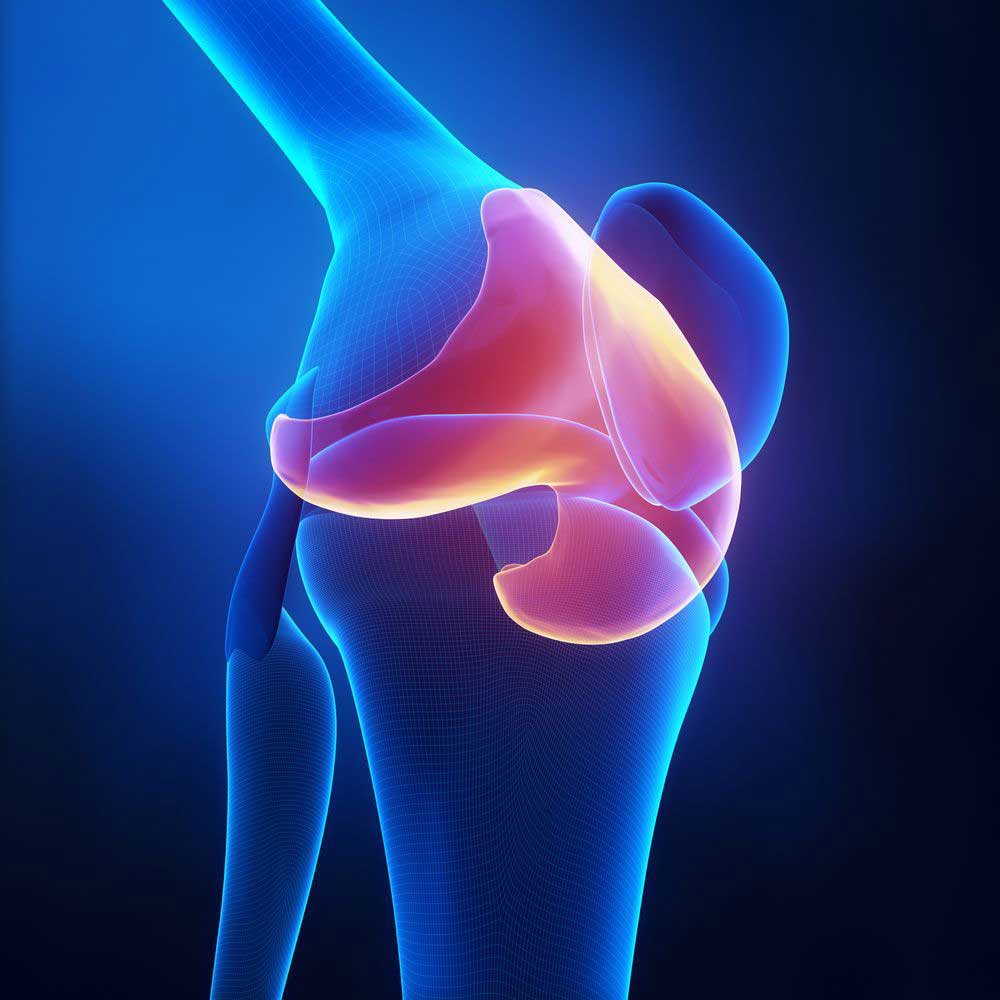 Osteochondral Defect Knee Football