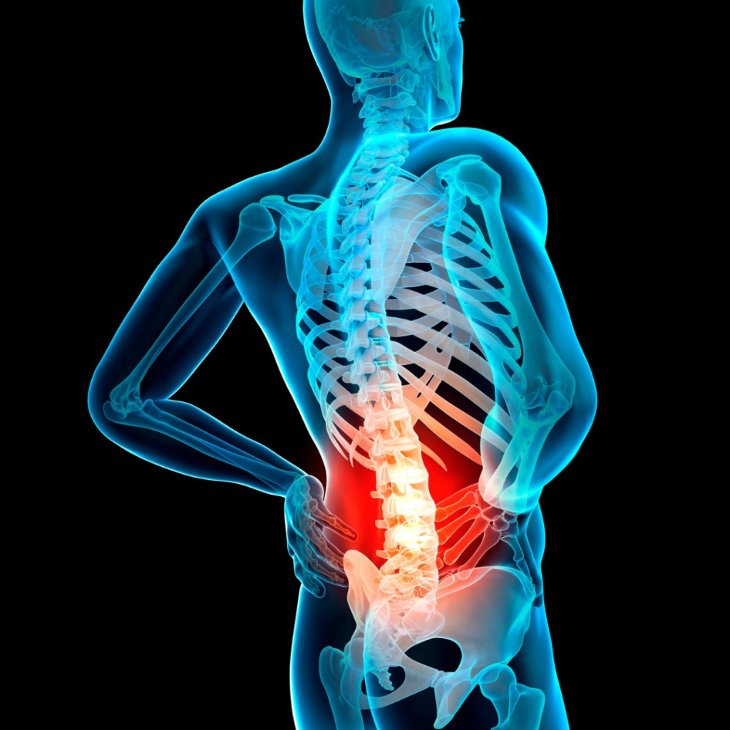 Spine Disc Injury Football Physio