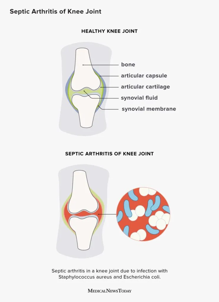 Septic Arthritis in Football Players The Football Physio