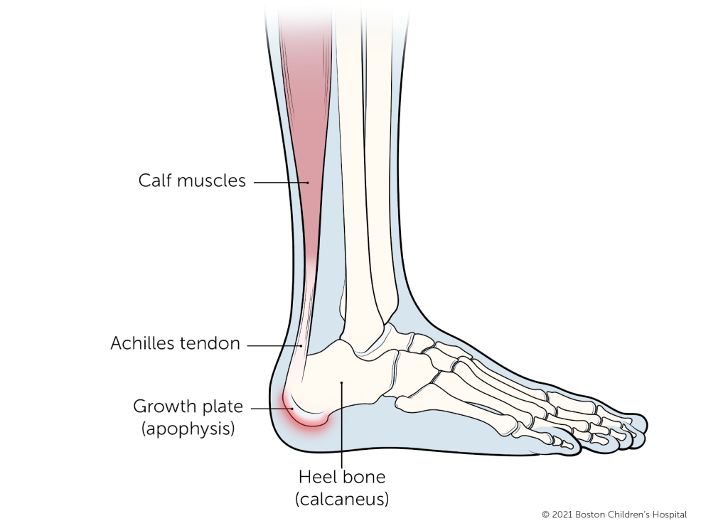 Sever's Disease in Football Players - The Football Physio